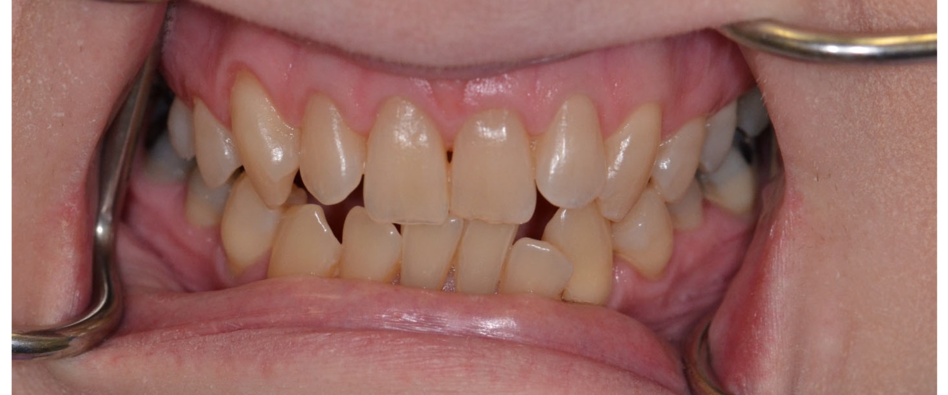 The Importance of Early Diagnosis and Treatment for Preventing Tooth Loss