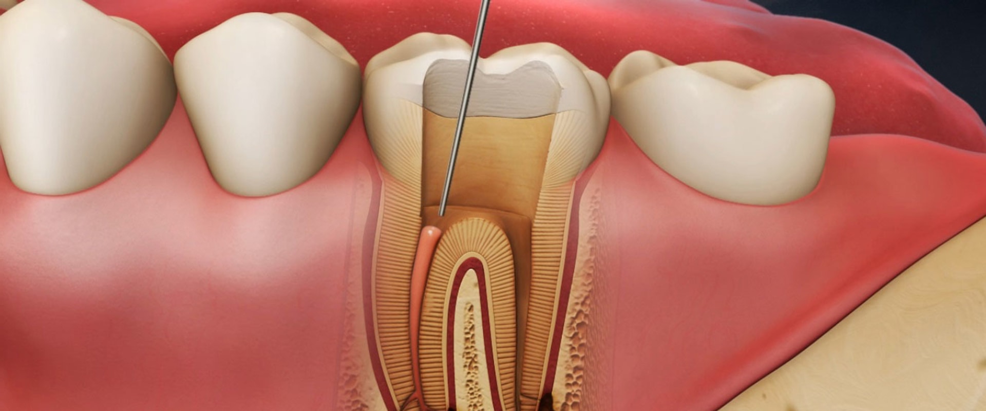 The Importance of Endodontic Treatments in Preventing Further Oral Complications
