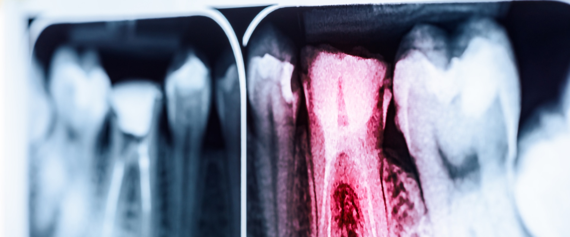 Signs that a Root Canal May Be Necessary