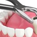 Exploring the Reasons for Tooth Extraction