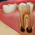 The Importance of Endodontic Treatments in Preventing Further Oral Complications