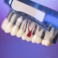 Understanding the Aftercare and Recovery Process for Root Canal Therapy