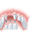 Options for Replacing Extracted Teeth: What You Need to Know