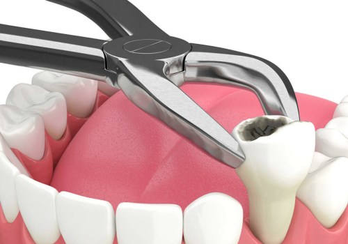 Exploring the Reasons for Tooth Extraction