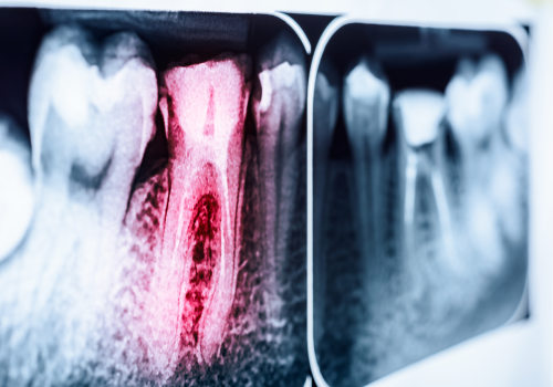 Signs that a Root Canal May Be Necessary