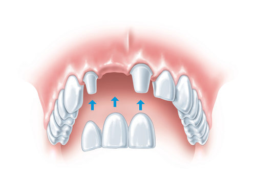 Options for Replacing Extracted Teeth: What You Need to Know